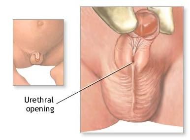 尿道下裂應(yīng)該做哪些檢查